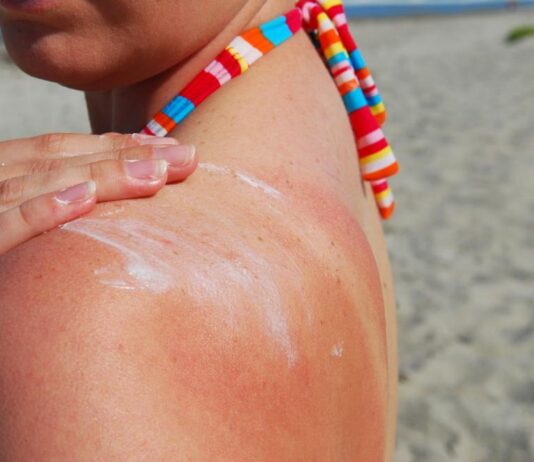 Британски експерти дават съвети за справяне със слънчевите изгаряния