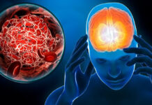 Всяка година над 40 000 души в България получават инсулт